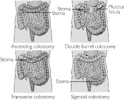 Ileotransverse colostomy | definition of ileotransverse colostomy by  Medical dictionary