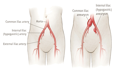 Causes of iliac aneurysm
