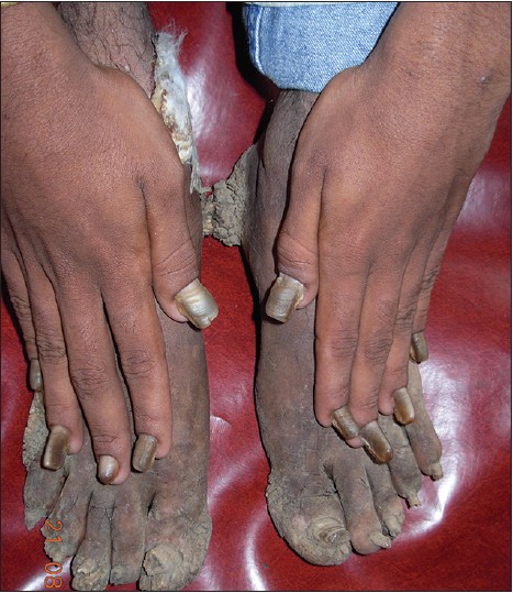 Figure 1: Clinical photograph of all nails showing thickened, lusterless  nail plate with subungual hyperkeratosis
