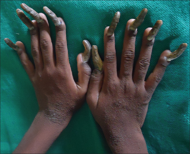 Figure 3: Thickened, discolored and increased curvature of fingernails