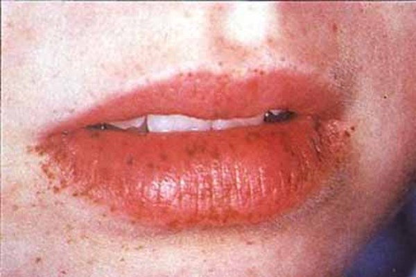 Children with Peutz-Jeghers syndrome often develop small, dark-colored  spots on the lips,