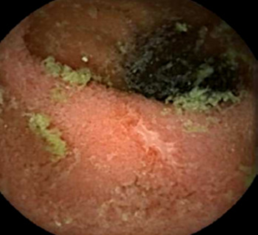 Capsule endoscopy demonstrating jejunoileitis with mucosal ulceration.