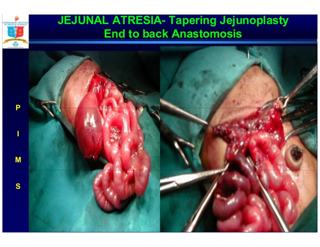 Unused Microcolon; 33. JEJUNAL ATRESIA- Tapering Jejunoplasty