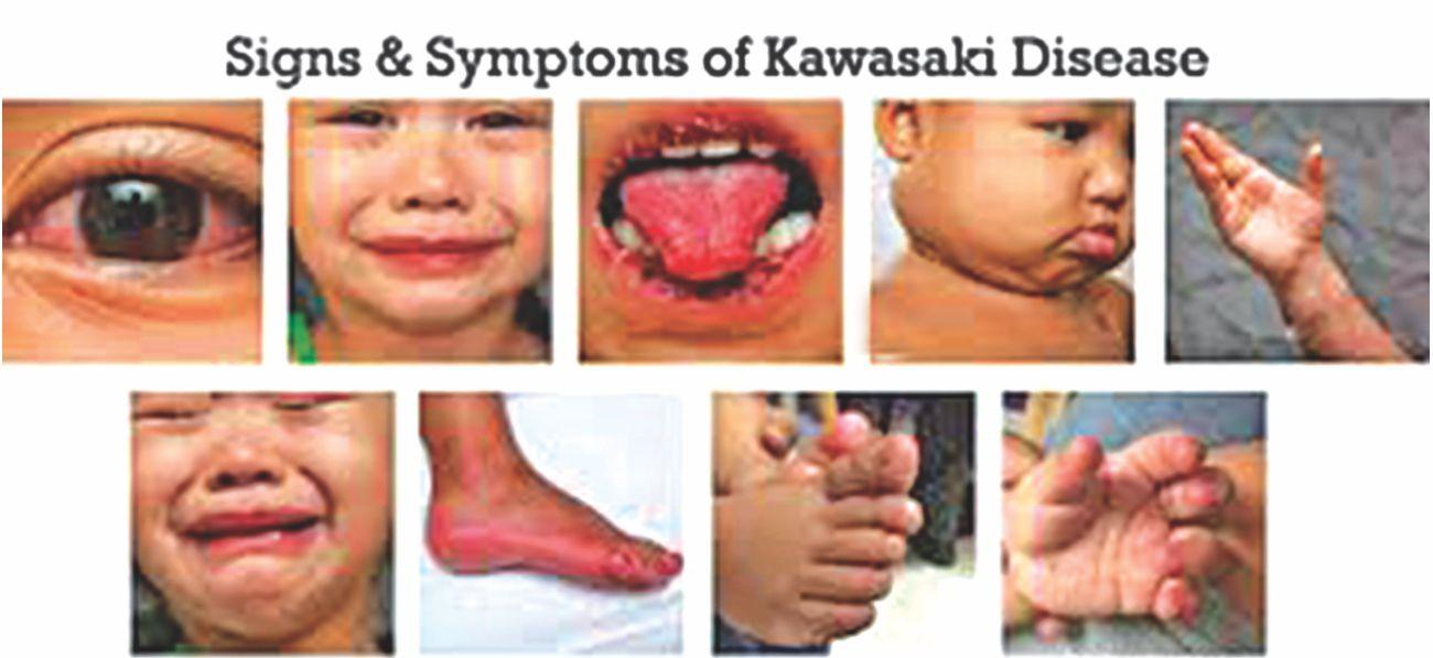 Milestone Colonial strategi kawasaki disease - Liberal Dictionary
