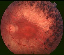 Pigmentary retinopathy[edit]