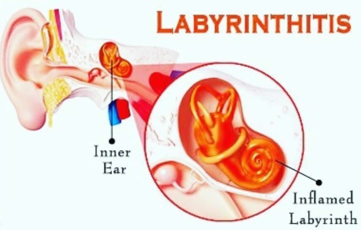 Labyrinthitis causes, symptoms, prognosis, diagnosis, exercise & treatment